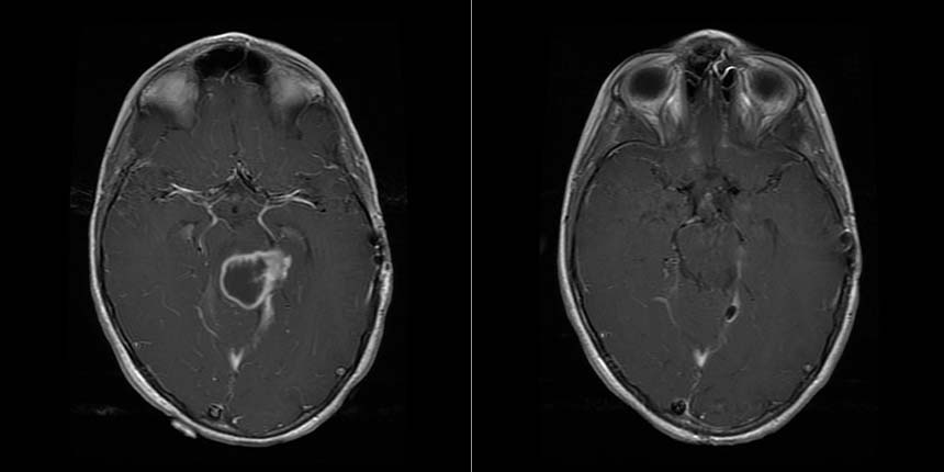 Anna's MRI before and after surgery