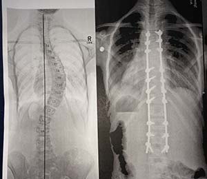 Katherine's spine x-rays