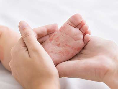 rashes-400-x-300 rashes
